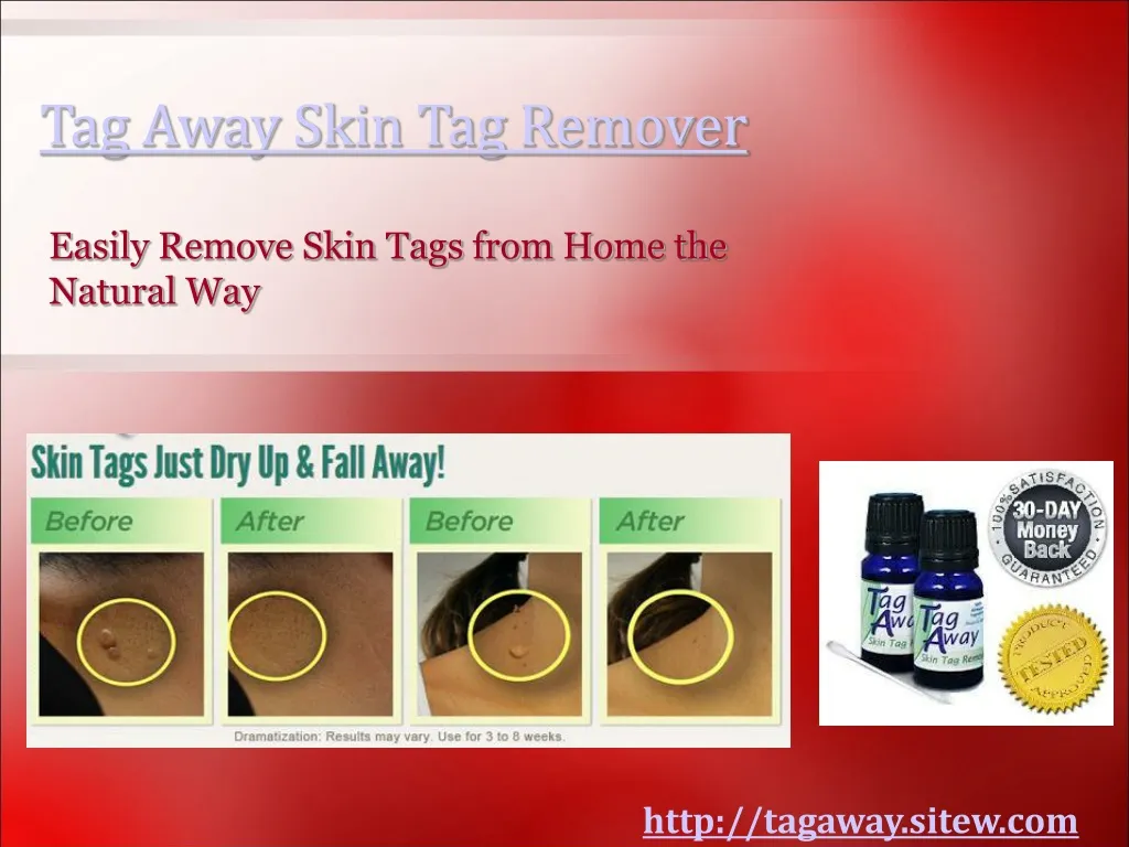 tag away skin tag remover