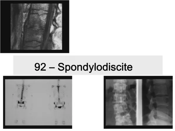 92 Spondylodiscite