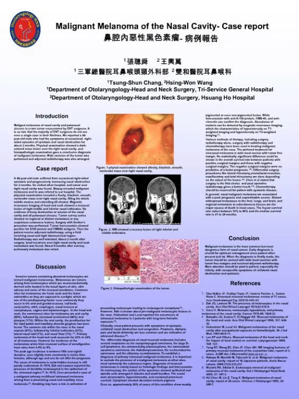 Malignant Melanoma of the Nasal Cavity- Case report -