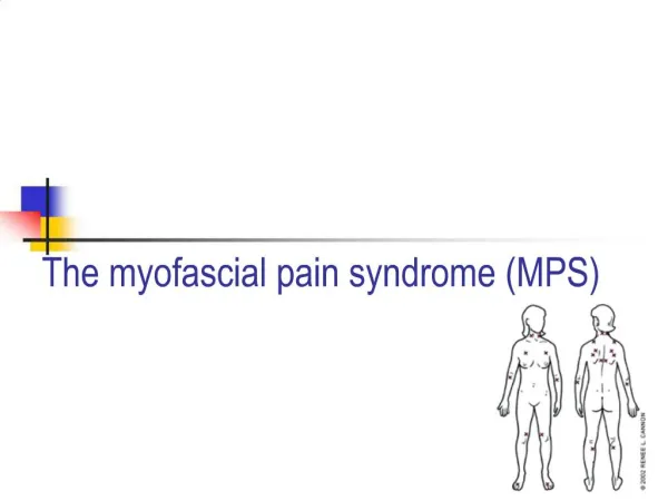 The myofascial pain syndrome MPS
