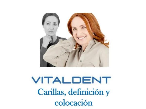 carillas definici n y colocaci n