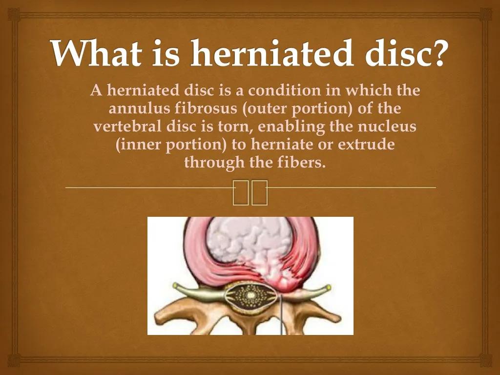 what is herniated disc