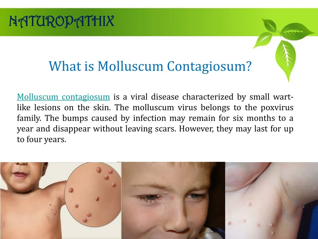 what is molluscum contagiosum