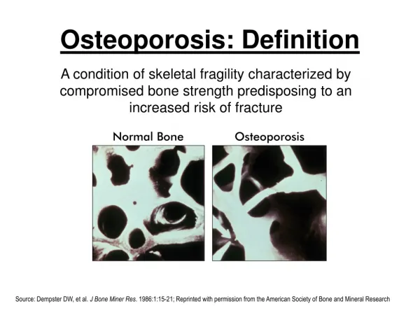 Osteoporosis - Definition
