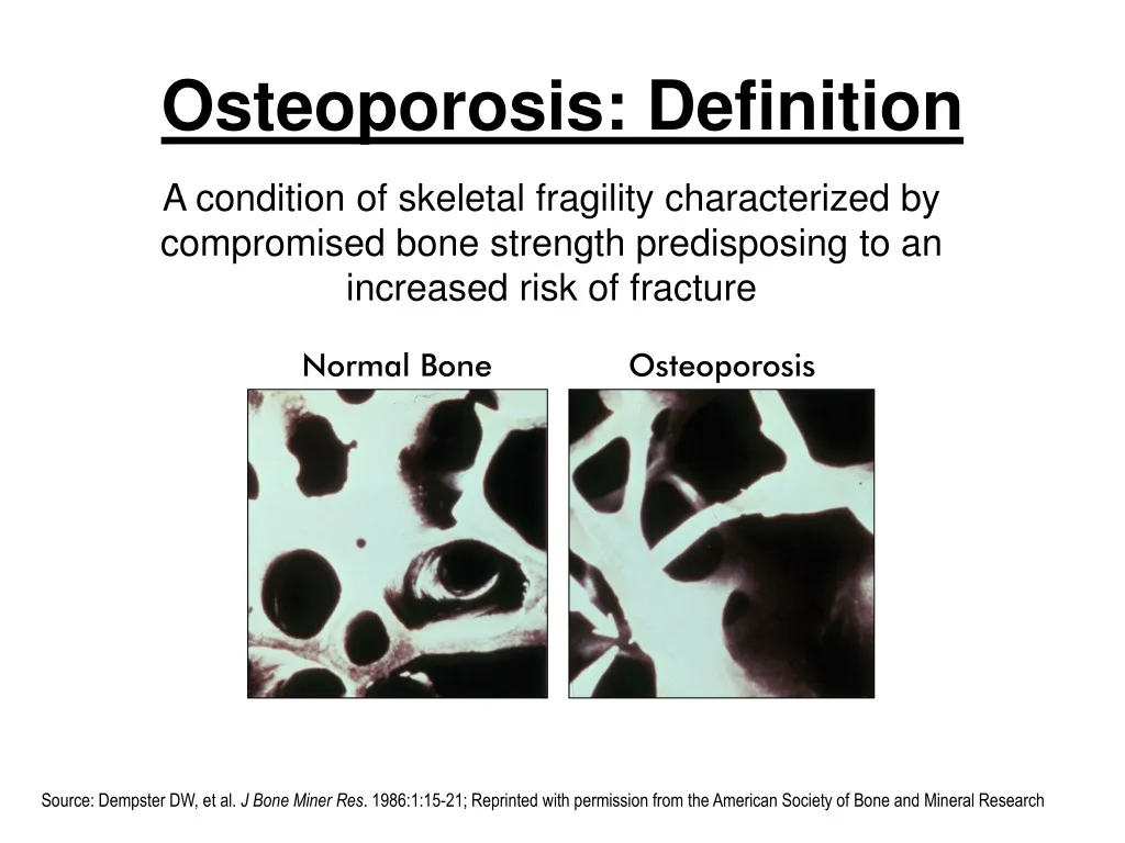 osteoporosis definition