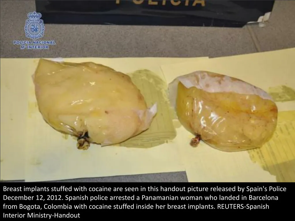 breast implants stuffed with cocaine are seen