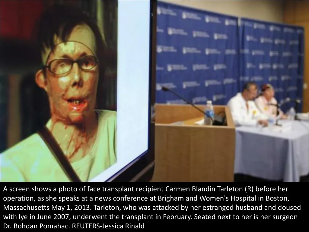 a screen shows a photo of face transplant