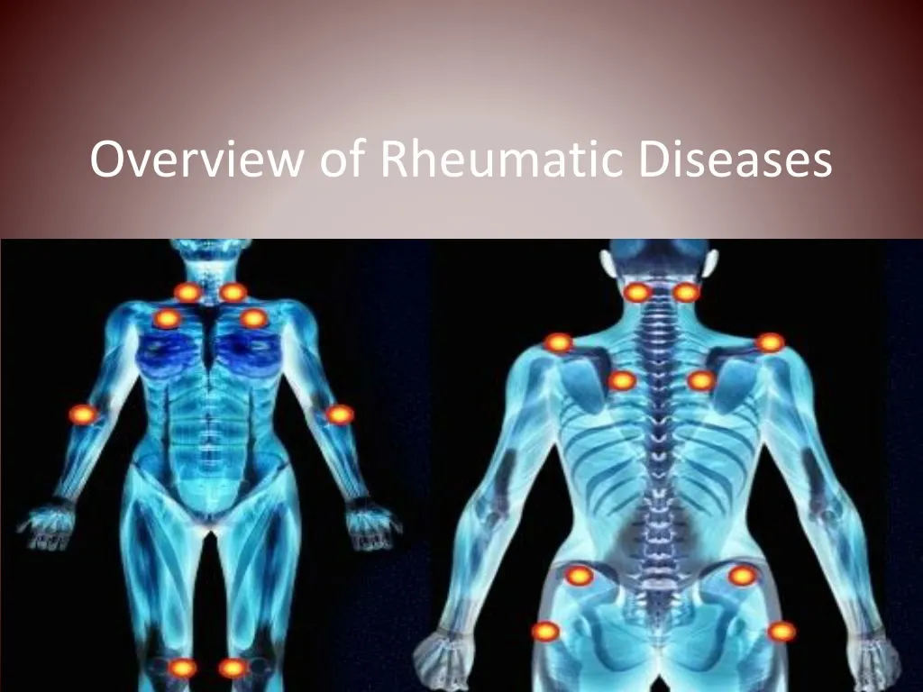 overview of rheumatic diseases