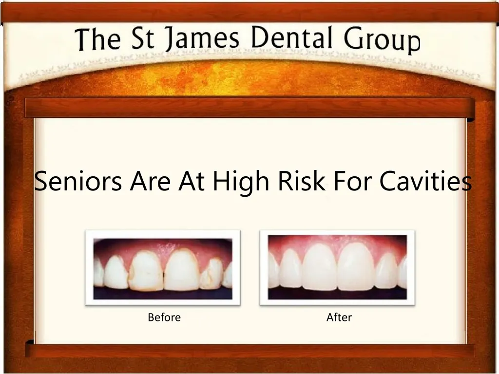 seniors are at high risk for cavities