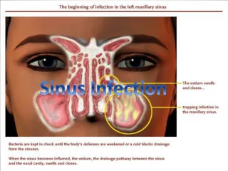 Natural Remedies for Sinus Problems - slide 1