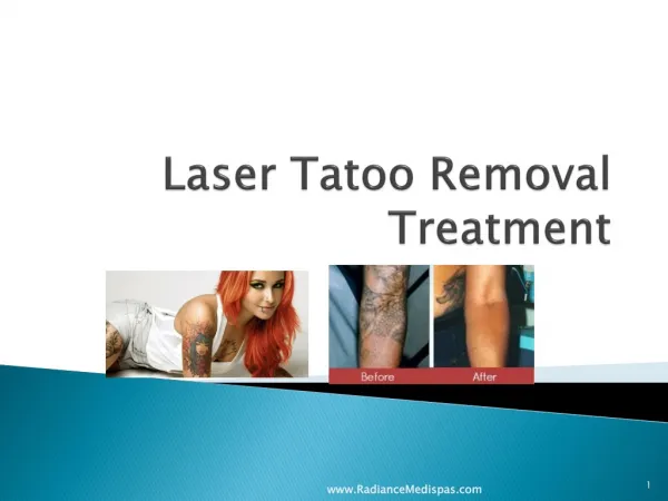 " Laser Tattoo Removal Procedure, Benefits"