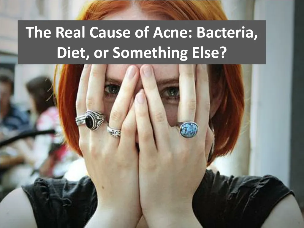the real cause of acne bacteria diet or something