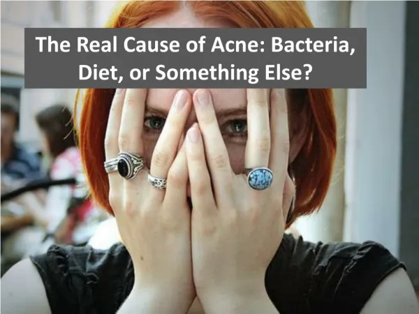 The real cause of acne; bacteria, diet, or something else?