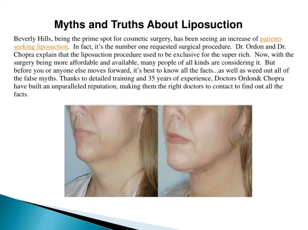 Myths and Truths About Liposuction