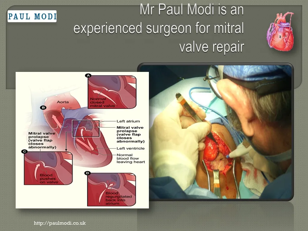 mr paul modi is an experienced surgeon for mitral valve repair