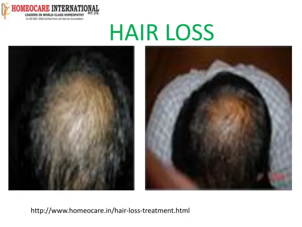 Homeopathic treatment for hair loss