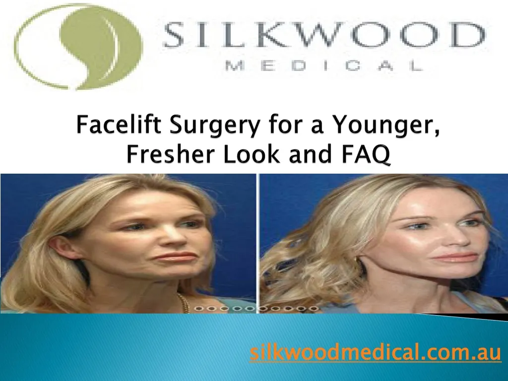 facelift surgery for a younger fresher look and faq
