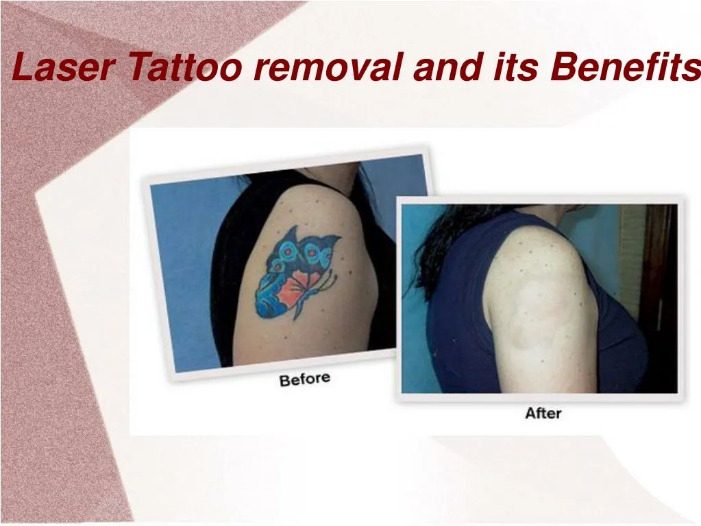 laser tattoo removal and its benefits