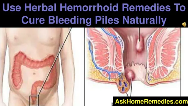Use Herbal Hemorrhoid Remedies To Cure Bleeding Piles Natura