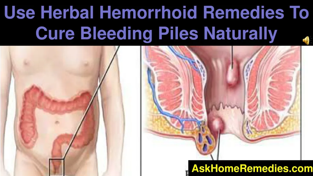 use herbal hemorrhoid remedies to cure bleeding
