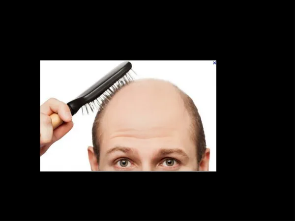 F.u.e. hair trasplant by t djemal medicina estetica