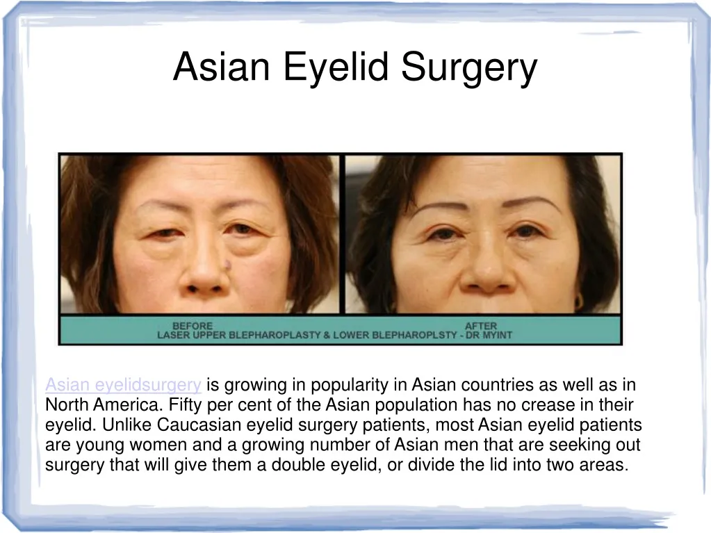 asian eyelid surgery
