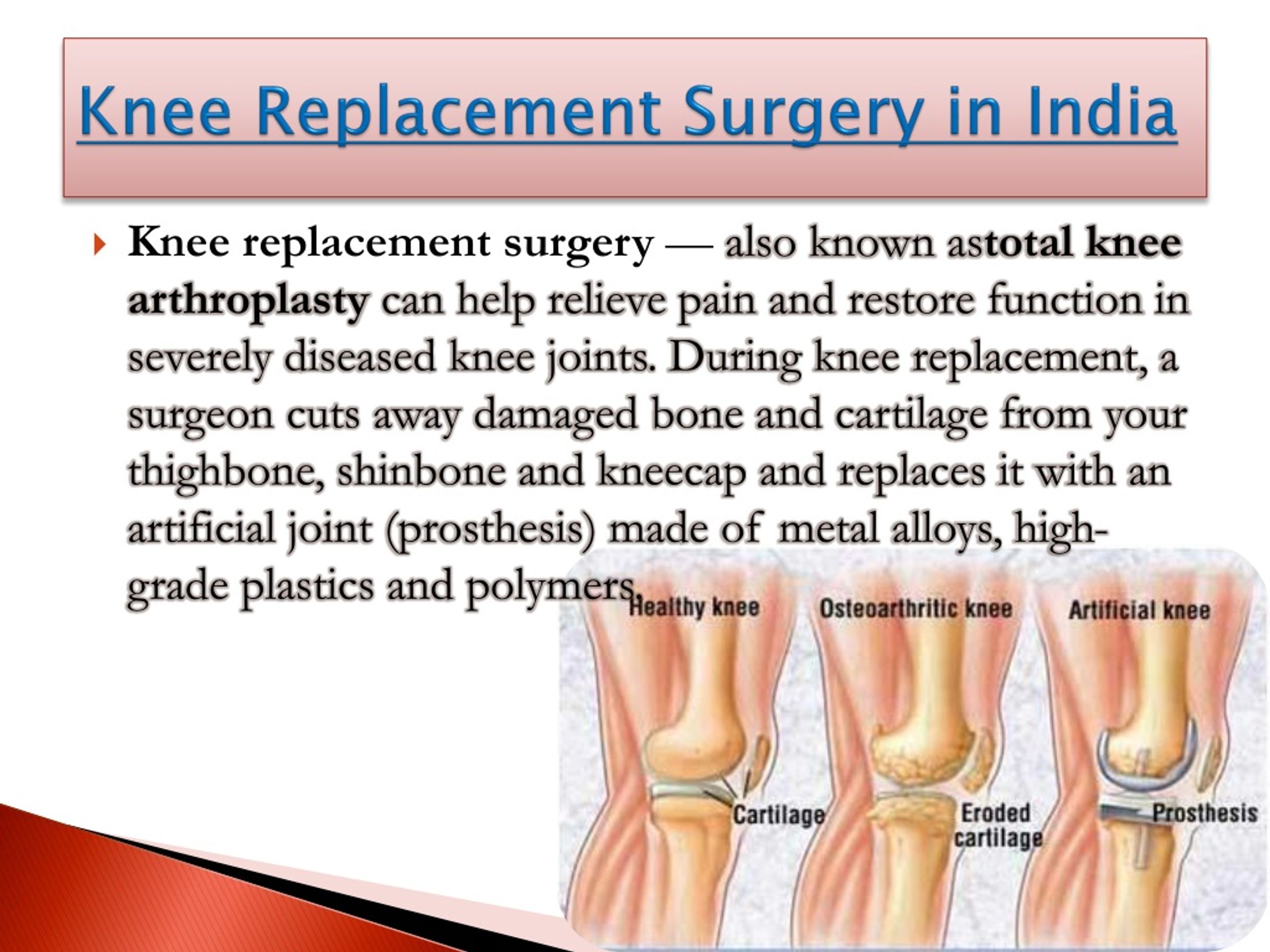 PPT - Knee replacement surgery PowerPoint Presentation, free download ...