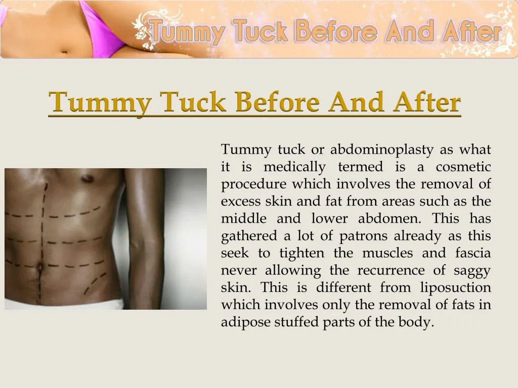 Comparison Between Liposuction and Tummy Tuck - AllureMedSpa