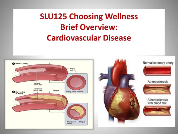 SLU125 Choosing Wellness Brief Overview: Cardiovascular Disease