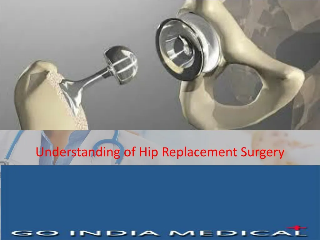 understanding of hip replacement surgery