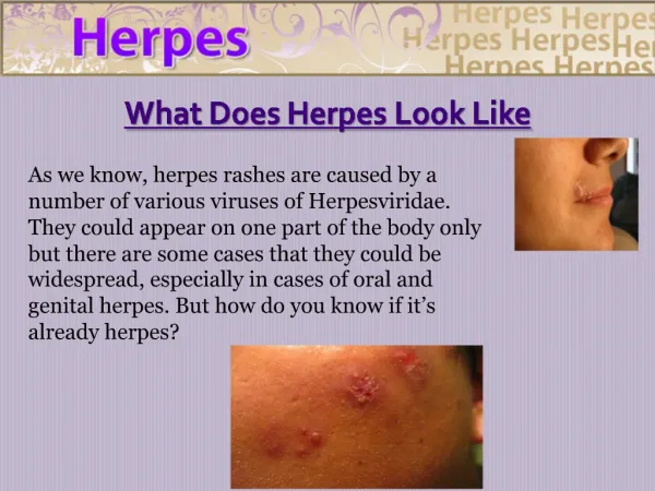 Herpes Cure
