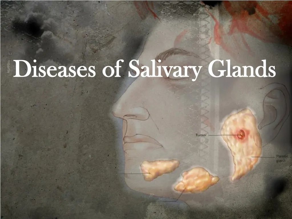 diseases of salivary glands