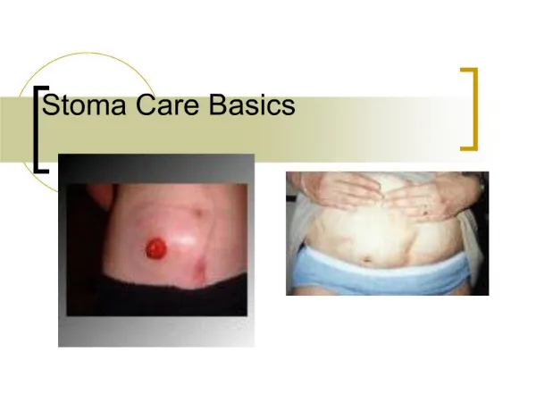 stoma care basics