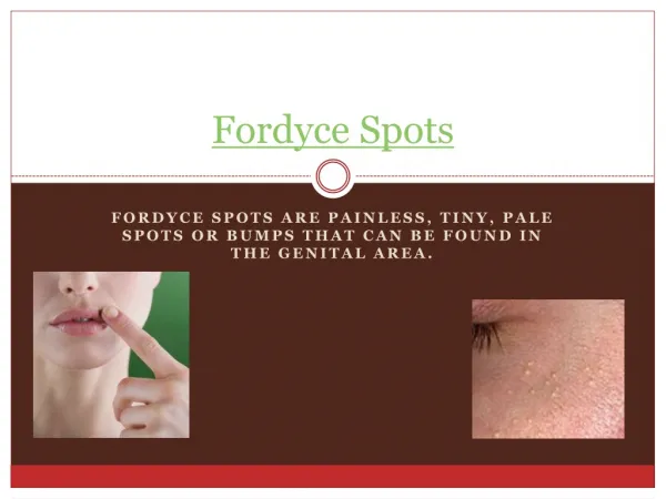 Fordyce Spots Treatment