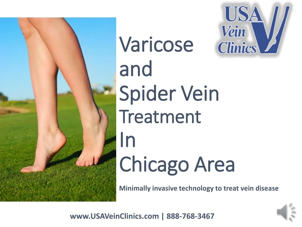 varicose and spider vein treatment in chicago area