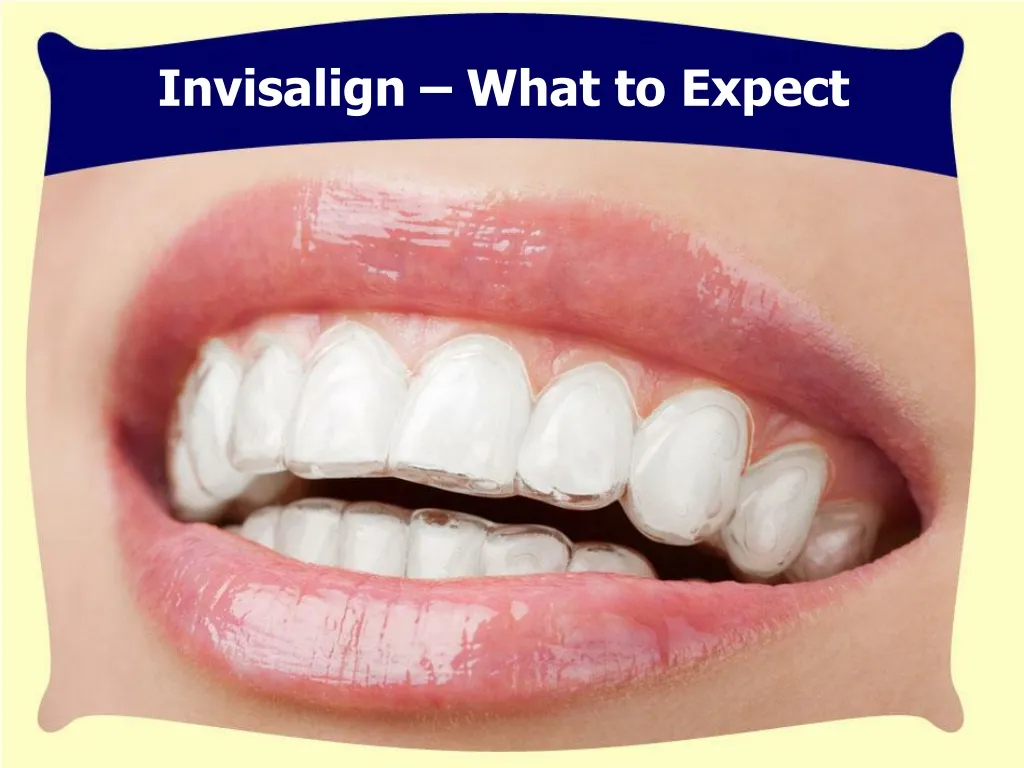 invisalign what to expect