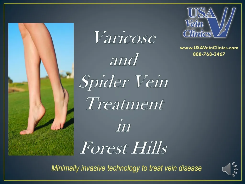 varicose and spider vein treatment in forest hills