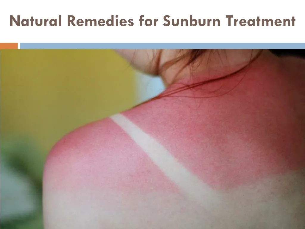 natural remedies for sunburn treatment