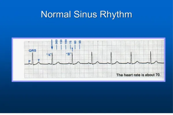 Normal Sinus Rhythm