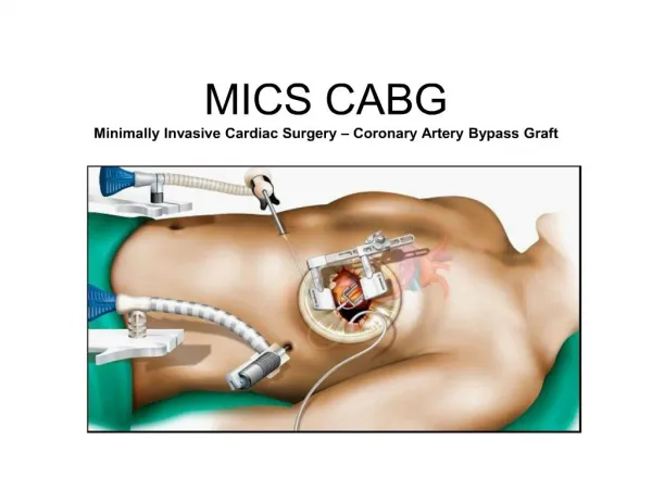 MICS CABG Minimally Invasive Cardiac Surgery Coronary Artery Bypass Graft