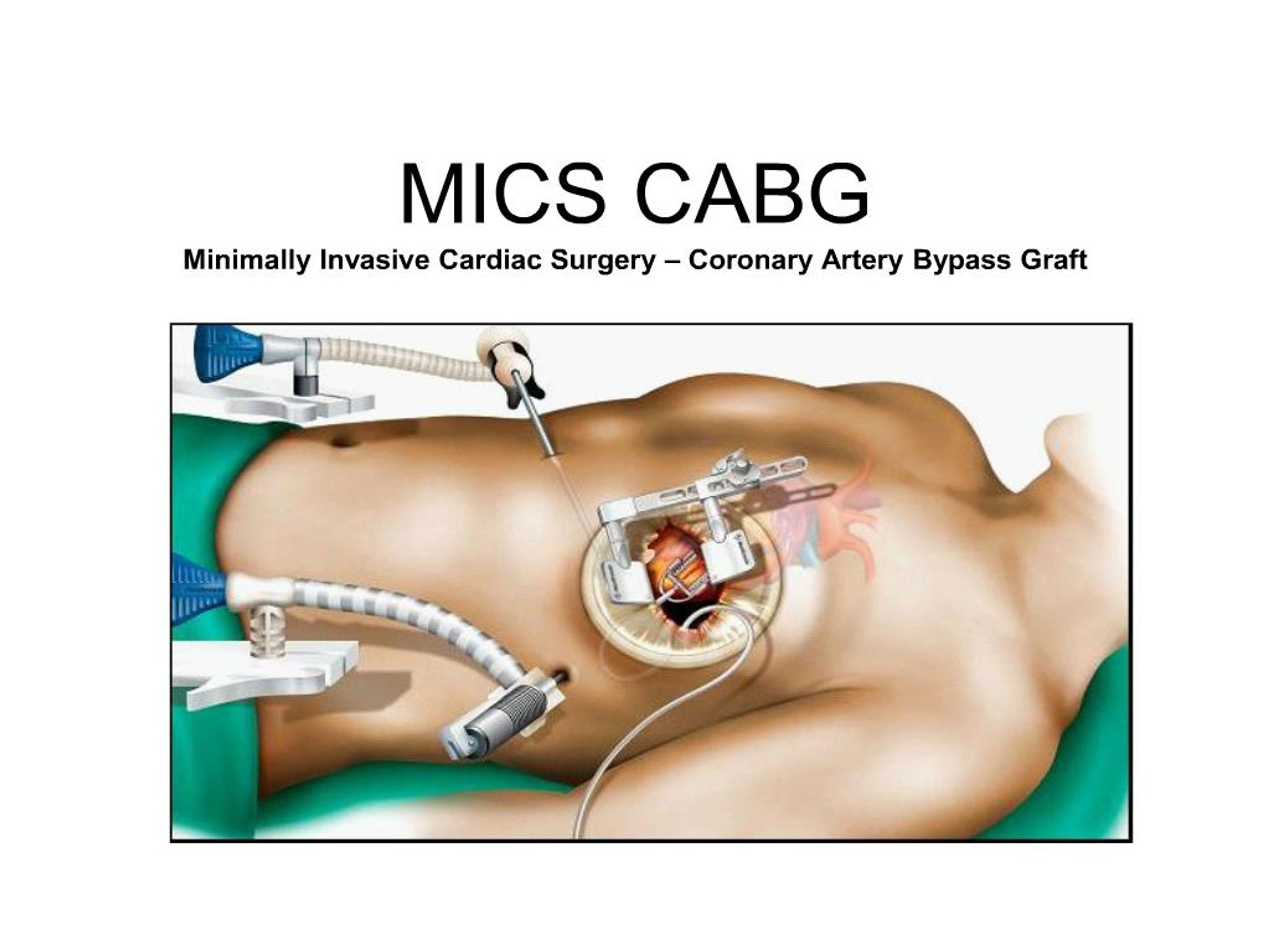 PPT - MICS CABG Minimally Invasive Cardiac Surgery Coronary Artery ...