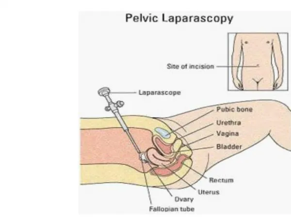 Complications of laparoscopy