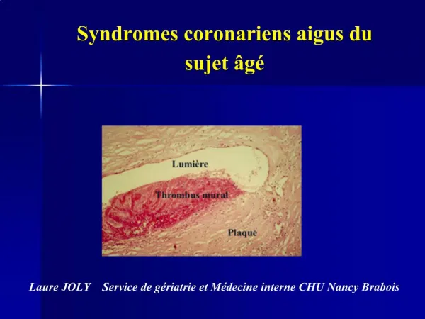Syndromes coronariens aigus du sujet g