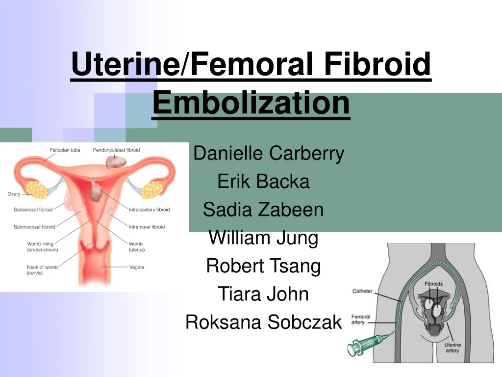 uterine femoral fibroid embolization