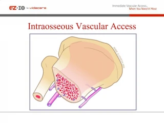 Intraosseous Vascular Access - slide 1