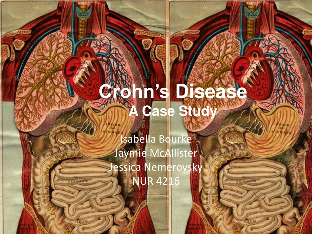 crohn s disease a case study