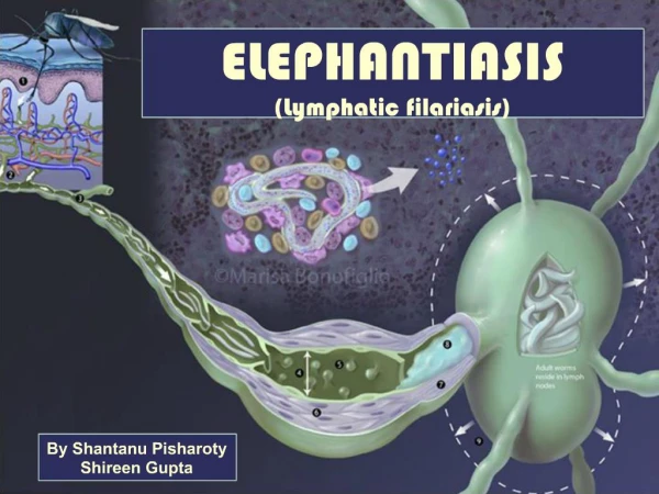 ELEPHANTIASIS Lymphatic filariasis