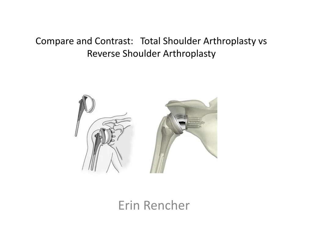 compare and contrast total shoulder arthroplasty vs reverse shoulder arthroplasty