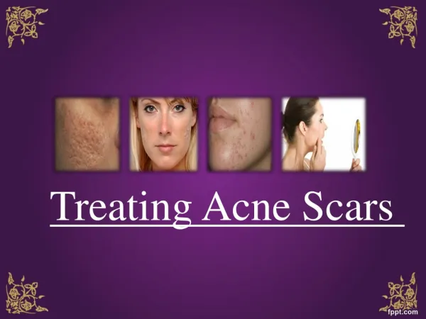 Treating Acne Scars