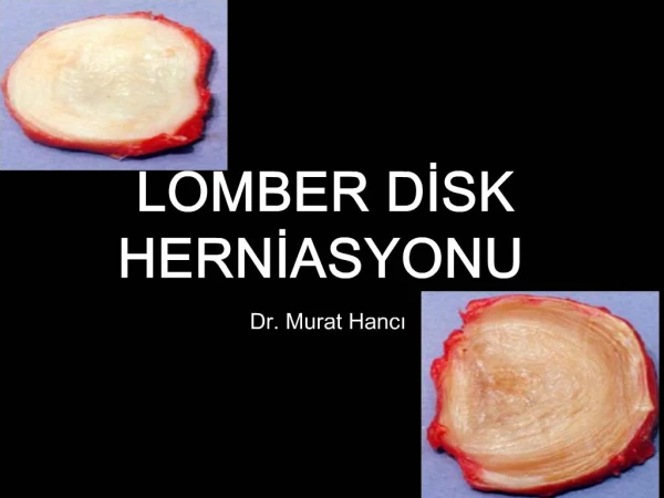LOMBER DISK HERNIASYONU Dr. Murat Hanci